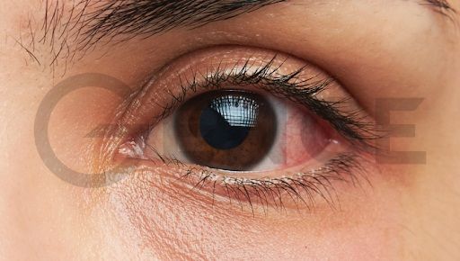 Nháy mắt trái – Mắt trái giật ở Nam và Nữ điềm báo gì?